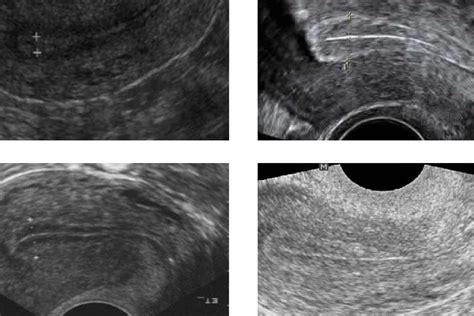 thick uterine lining positive pregnancy test|urine thickness after pregnancy test.